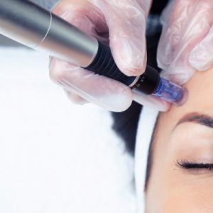 Microneedling mit Tiefenreinigung
