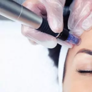 Microneedling mit Tiefenreinigung